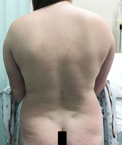 Vaser Liposuction Before & After Patient #228