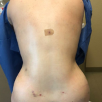 Vaser Liposuction Before & After Patient #228