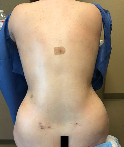 Vaser Liposuction Before & After Patient #228