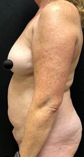 Vaser Liposuction Before & After Patient #231