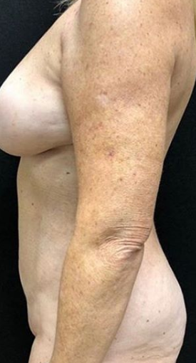 Vaser Liposuction Before & After Patient #231