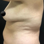 Vaser Liposuction Before & After Patient #234