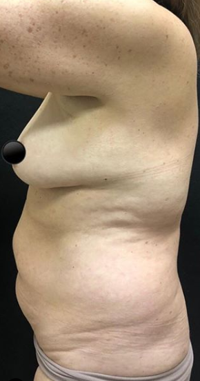 Vaser Liposuction Before & After Patient #234