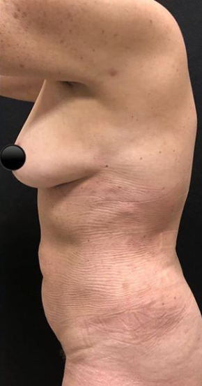 Vaser Liposuction Before & After Patient #234