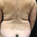 Vaser Liposuction Before & After Patient #243
