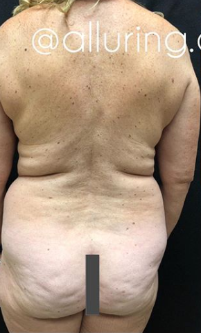 Vaser Liposuction Before & After Patient #243