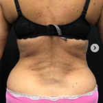Vaser Liposuction Before & After Patient #243