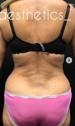 Vaser Liposuction Before & After Patient #243