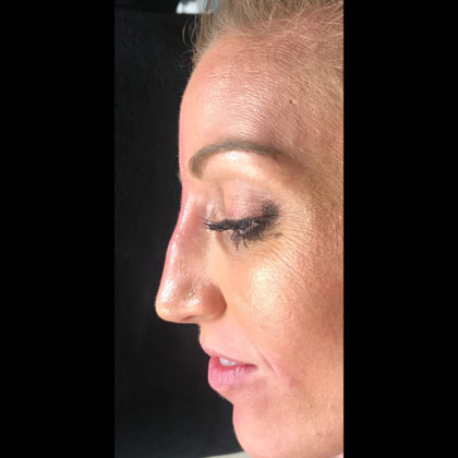 Non-surgical Rhinoplasty Before & After Patient #612