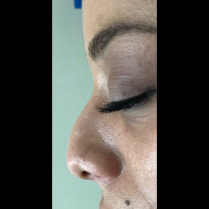 Non-surgical Rhinoplasty Before & After Patient #615