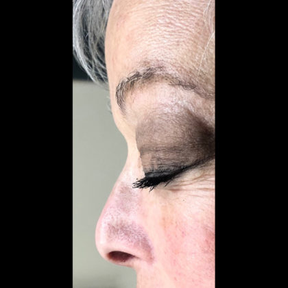 Non-surgical Rhinoplasty Before & After Patient #618