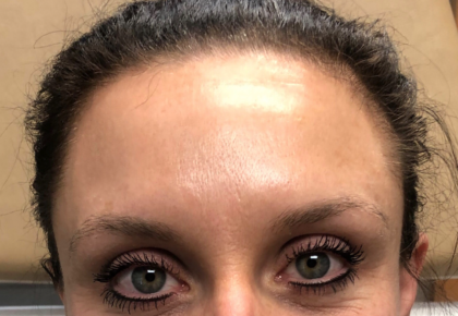 Botox Before & After Patient #670