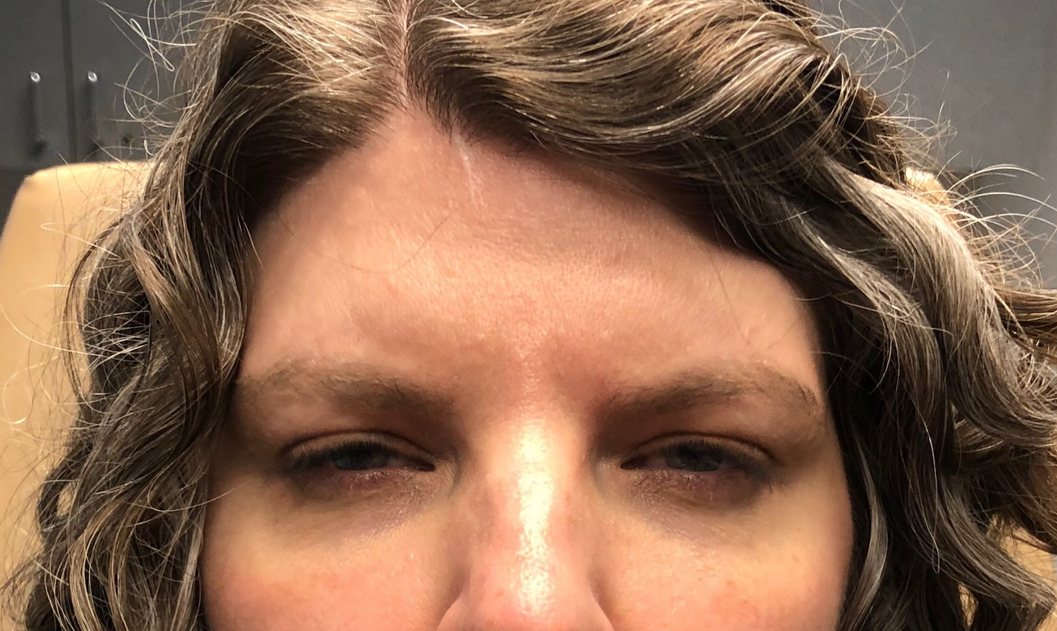 Botox Before & After Patient #672