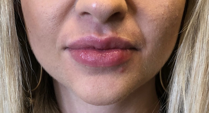 Juvéderm Before & After Patient #709