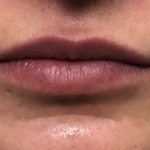 Juvéderm Before & After Patient #814