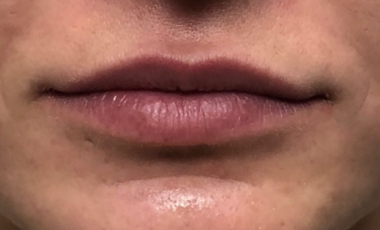 Juvéderm Before & After Patient #814