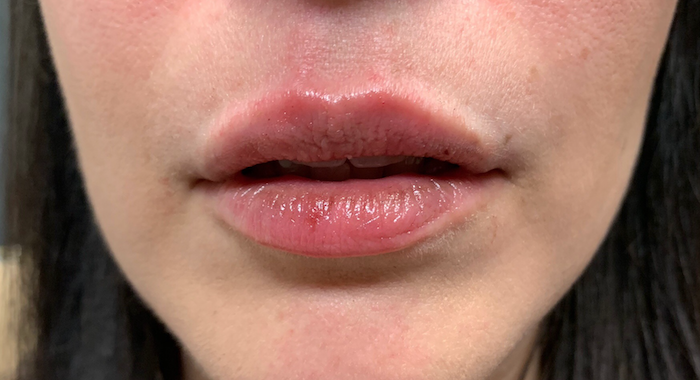 Juvéderm Before & After Patient #715