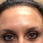 Botox Before & After Patient #670
