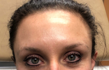 Botox Before & After Patient #670