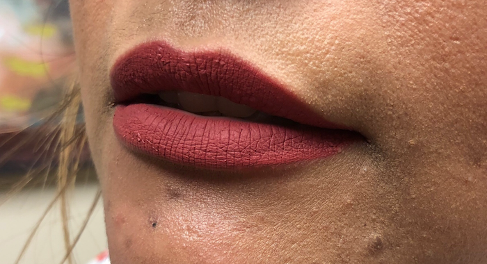 Juvéderm Before & After Patient #718