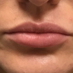 Juvéderm Before & After Patient #724