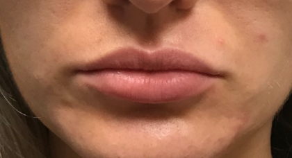 Juvéderm Before & After Patient #724