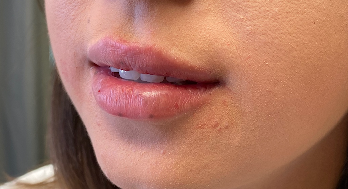 Juvéderm Before & After Patient #736