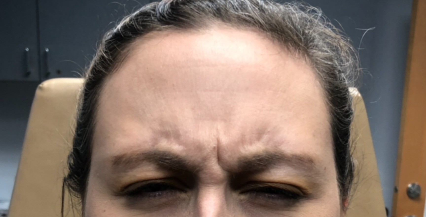 Botox Before & After Patient #629
