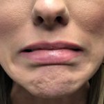 Botox Before & After Patient #673