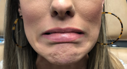 Botox Before & After Patient #673