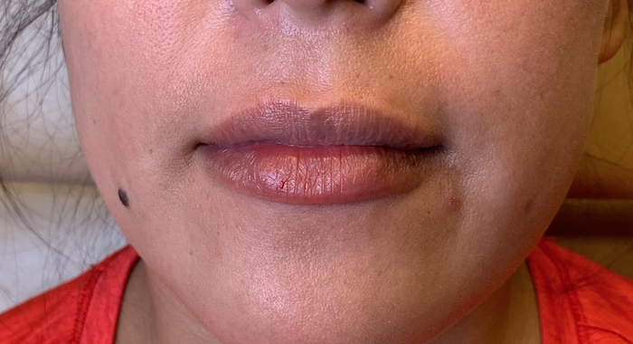 Juvéderm Before & After Patient #757