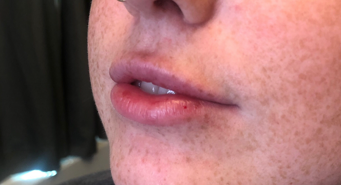 Juvéderm Before & After Patient #766