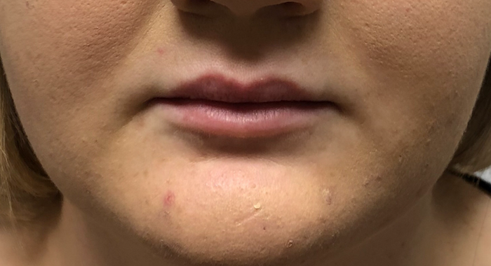 Juvéderm Before & After Patient #769