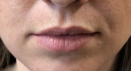 Juvéderm Before & After Patient #790