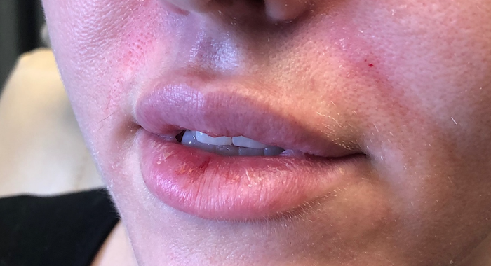 Juvéderm Before & After Patient #793