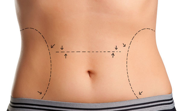 Abdominoplasty Candidates