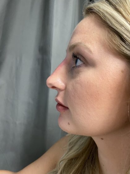 Non-surgical Rhinoplasty Before & After Patient #862
