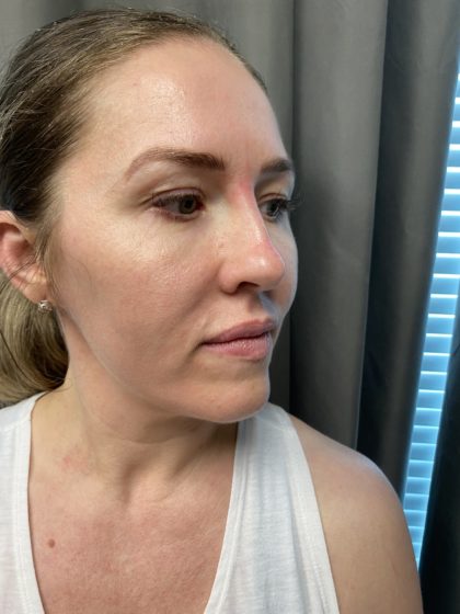 Non-surgical Rhinoplasty Before & After Patient #904
