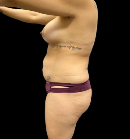 Vaser Liposuction Before & After Patient #912