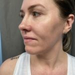 Non-surgical Rhinoplasty Before & After Patient #904