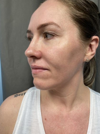 Non-surgical Rhinoplasty Before & After Patient #904