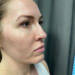 Non-surgical Rhinoplasty Before & After Patient #904