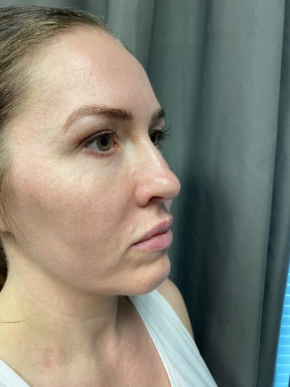 Non-surgical Rhinoplasty Before & After Patient #904