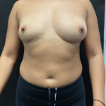 Breast Augmentation Before & After Patient #927