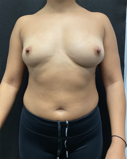 Breast Augmentation Before & After Patient #927