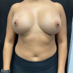 Breast Augmentation Before & After Patient #927