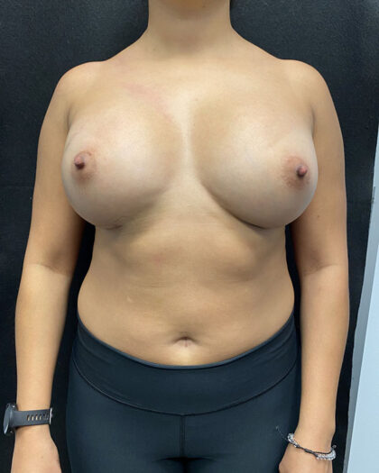 Breast Augmentation Before & After Patient #927