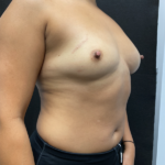 Breast Augmentation Before & After Patient #927