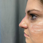 Non-surgical Rhinoplasty Before & After Patient #932
