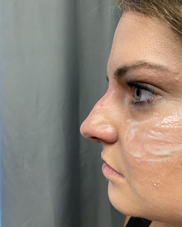 Non-surgical Rhinoplasty Before & After Patient #932